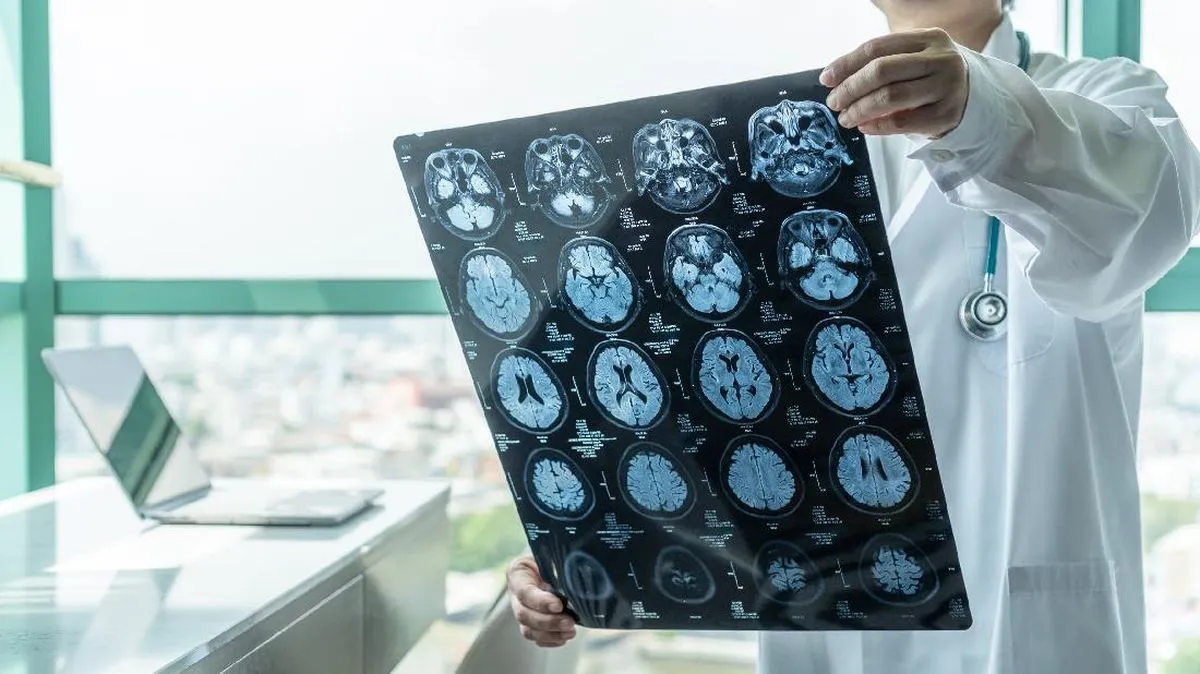 Viral Perempuan 20 Tahun Kena Stroke, Dokter Ungkap Penyebabnya