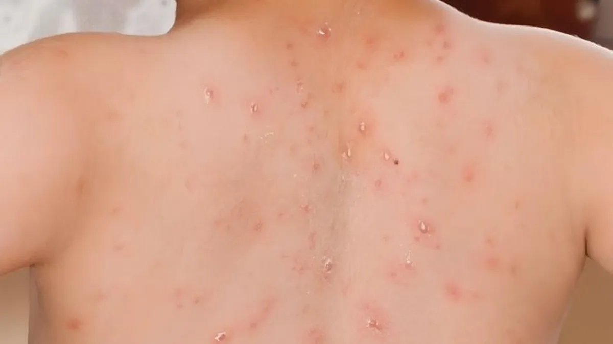 WHO Ungkap Peningkatan Kasus Campak Global: Kematian Turun, Wabah Melonjak Tiga Kali Lipat