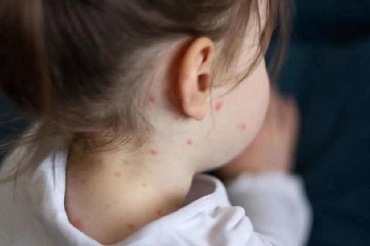 WHO Ungkap Kematian Akibat Campak Turun 88 Persen, Tapi Kasusnya Melonjak!