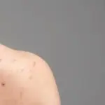 5 Metode Efektif Mengatasi Jerawat Punggung di Rumah: Jaga Kulit Sehat dan Bebas Noda