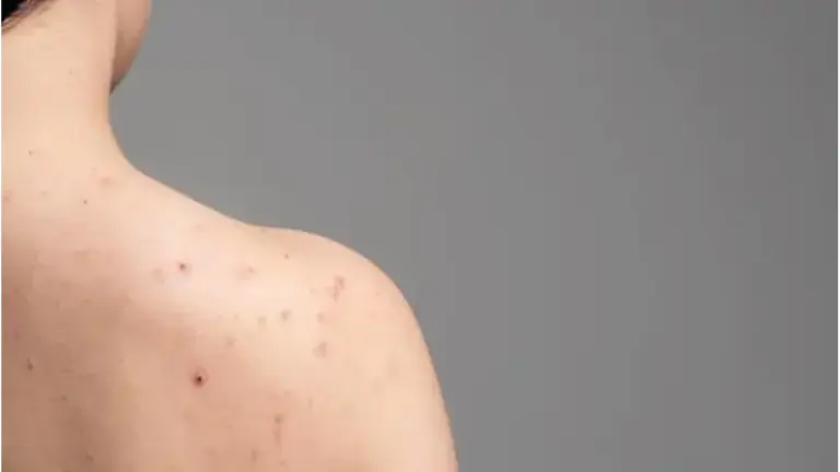 5 Metode Efektif Mengatasi Jerawat Punggung di Rumah: Jaga Kulit Sehat dan Bebas Noda