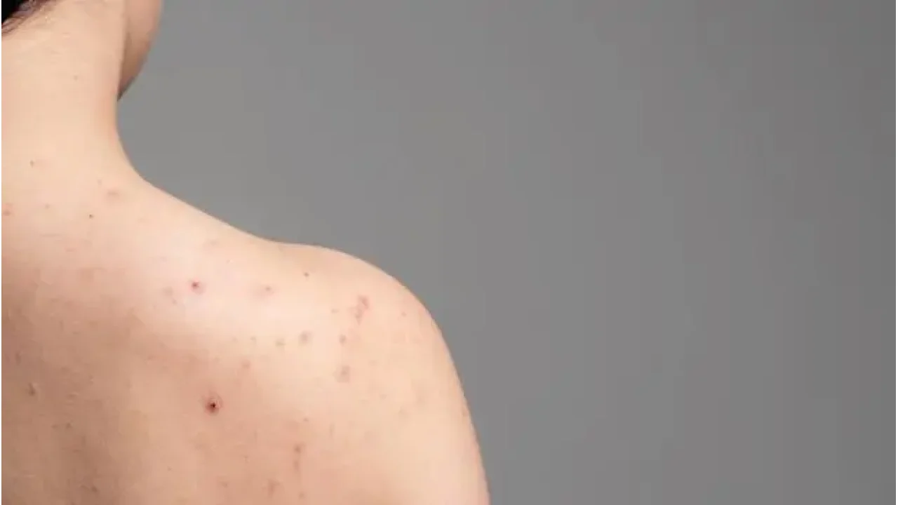 5 Metode Efektif Mengatasi Jerawat Punggung di Rumah: Jaga Kulit Sehat dan Bebas Noda