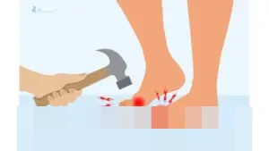 Nyeri Tak Tertahankan dan Stigma: Mengapa Asam Urat Kini Menjadi Momok Global yang Kian Meluas?