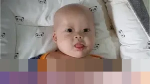 Perjuangan Tak Kenal Lelah Chiara, Bayi 8 Bulan dengan Teratoma Immature, Down Syndrome, dan Jantung Bocor