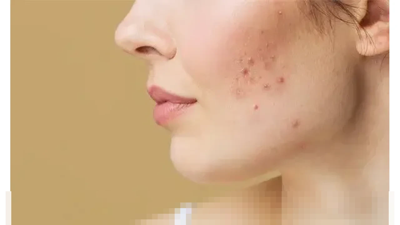 Waspada! 15 Pemicu Breakout Kulit yang Sering Terabaikan, dari Produk hingga Stres